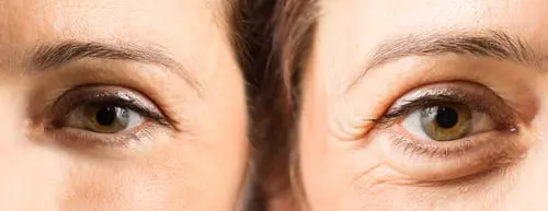 Eyes (Crow’s Feet) anti wrinkles treatment