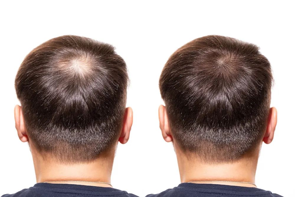 A 100% Effective Non-Surgical Procedure of PRP Hair Restoration