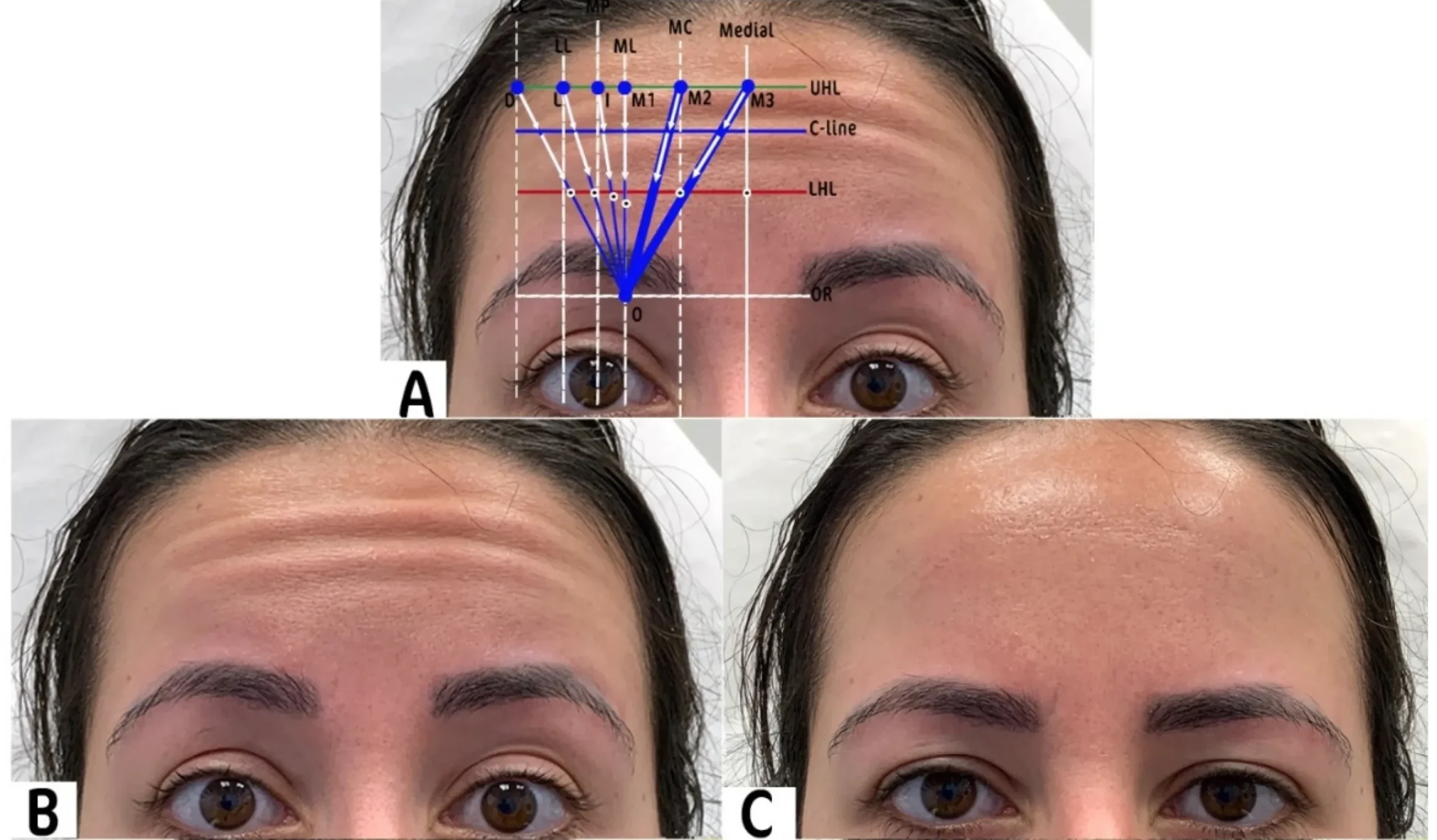 Forehead anti wrinkles treatment